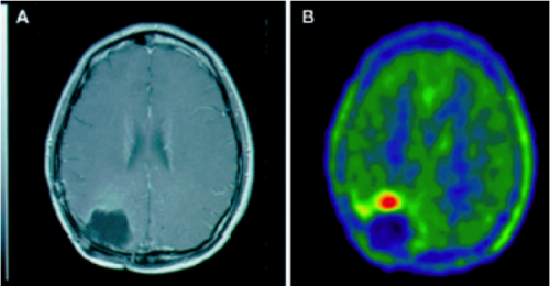 FET showing recurrent glioma (B) with no MRI abnormality (A)