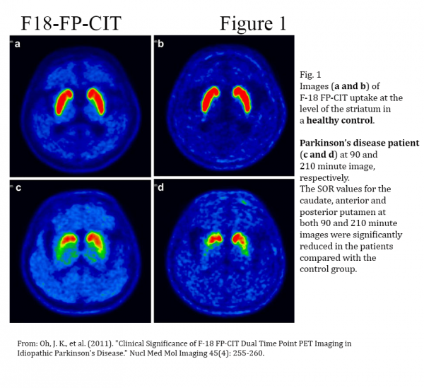 Deuk echtgenoot web ASAN Medical Centre and Duchembio, Korea, licence DAT PET tracer for  Parkinson's to Cyclotek - Cyclotek